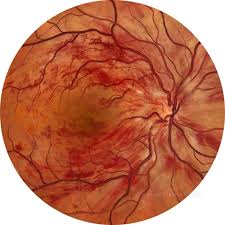 11. Retinal Vein & Artery Occlusion Treatment