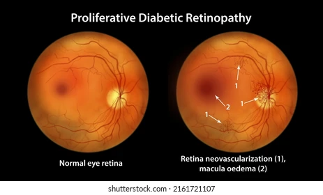 10. Diabetic Retinopathy Care & Advanced Retina Treatment