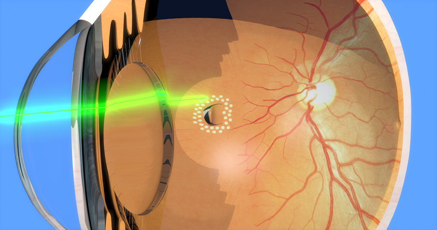 16. Retinal Laser Treatment (PRP & Barrage Laser)