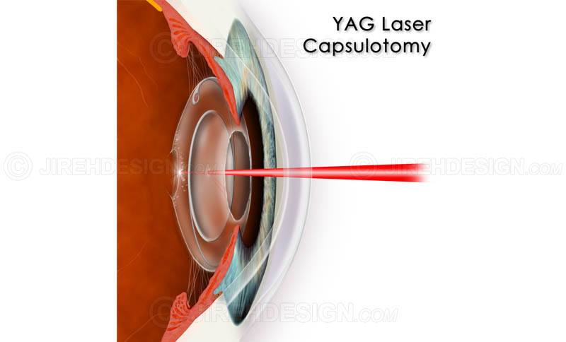 5. Advanced Eye Procedures & Laser Vision Treatments