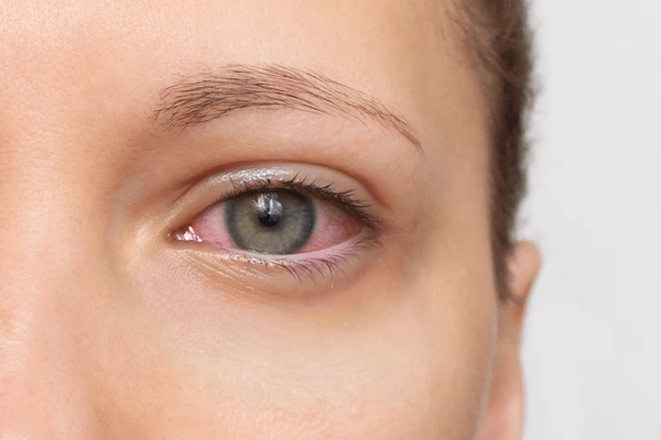 2. Comprehensive Dry Eye Diagnosis & Advanced Dry Eye Treatment